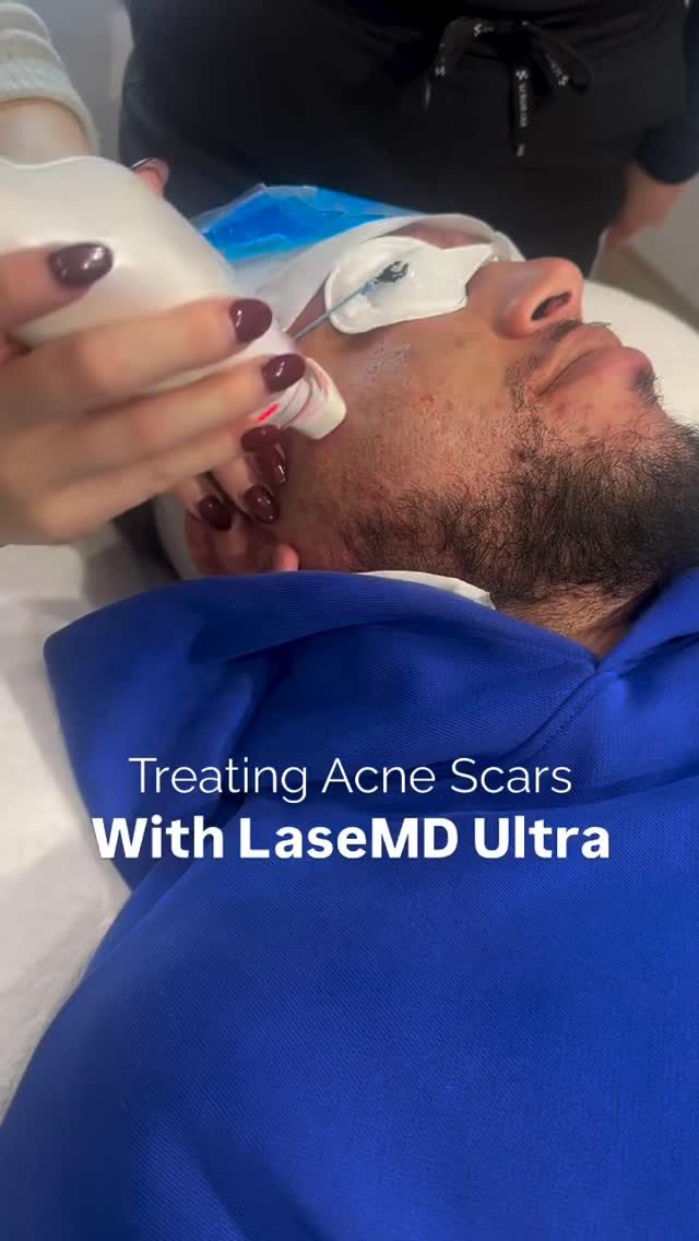 At Me Skin & Body in South Yarra, the LaseMD Ultra treatment is helping clients smooth, refine, and refresh their skin – particularly for softening and fading acne scars.

This non-ablative fractional laser creates thousands of ultra-fine microchannels in the skin, stimulating natural collagen and elastin production to replace old, scarred tissue with fresh, healthy skin. The result? A smoother texture, a brighter tone, and scars that appear softer and less visible – all with minimal downtime.

📍2 / 168-172 Toorak Road South Yarra

🎥 (c) @meskinandbody